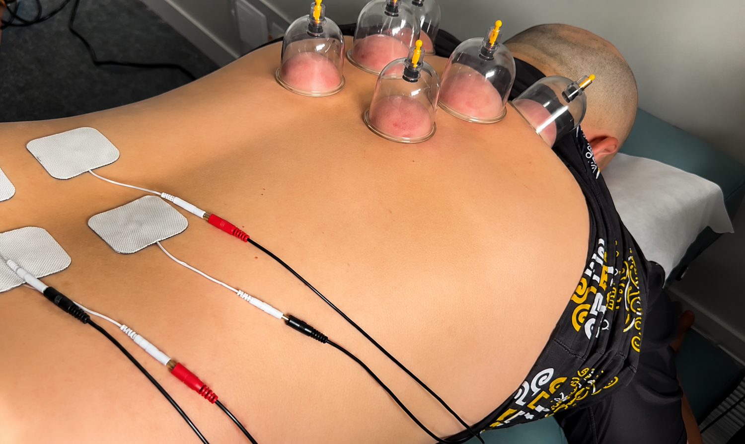 Cupping and EMS therapy on a patient's back for crash-injury recovery at Chiroport